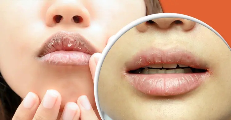 শীতে ঠোঁট ফাটার কারণ ও সহজ প্রতিকার