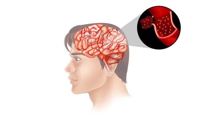 তরুণদের মধ্যে স্ট্রোকের প্রবণতা বাড়ছে কেন?